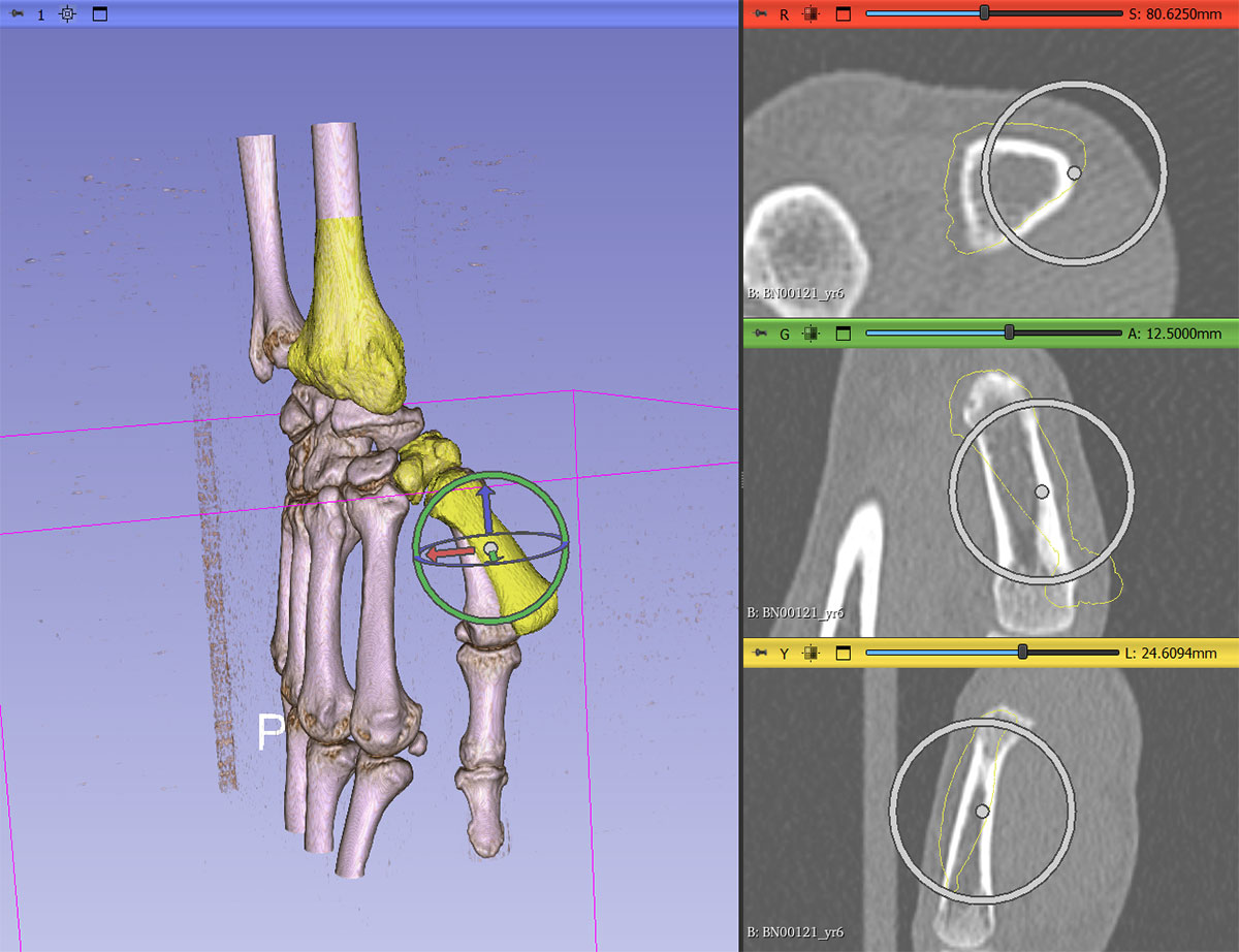 AutoscoperM Hierarchical 3D Registration in Action: AutoscoperM’s Hierarchical 3D Registration extension for 3D Slicer automates six-DOF rigid alignment of skeletal anatomy. In this example, tracking a metacarpal bone across a 3D CT sequence. It defines ROIs around each bone, registers the root node first, then propagates optimized transforms through the anatomical hierarchy for accurate motion and kinematic analysis.